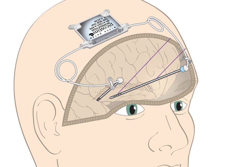 🧠 Tiny implant could turn back the clock for Parkinson's patients